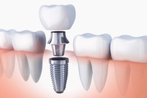 Dental Implant1112