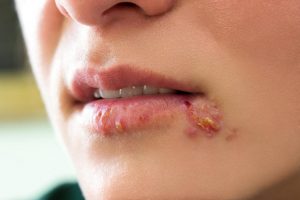Female Signs and symptoms Herpes