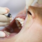 Receding Gums Treatment Singapore: What is the Fastest Way to Heal Receding Gums?