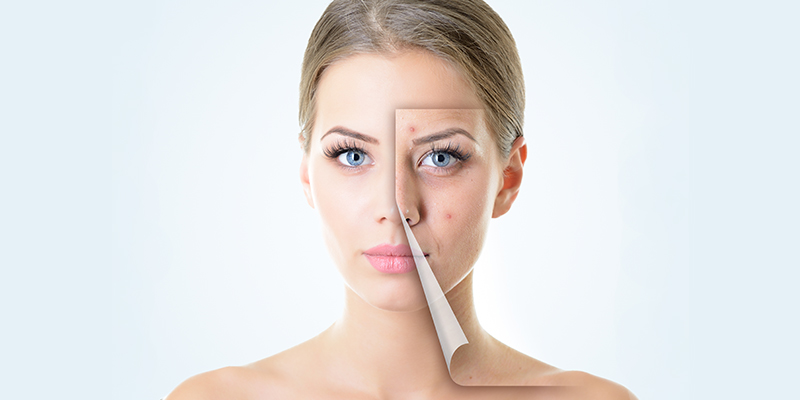 Goodbye to Acne