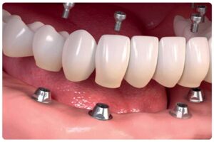 Dental Implants