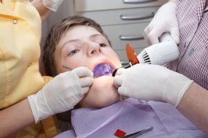 Dental Sealantss