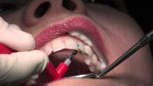 Closer Look at Composite Fillings
