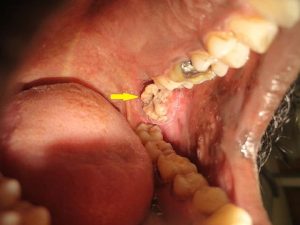 OSMF and Oral Cancer