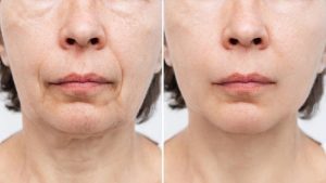 Non-Surgical Facelifts for a Youthful, Lifted Skin Without Surgery